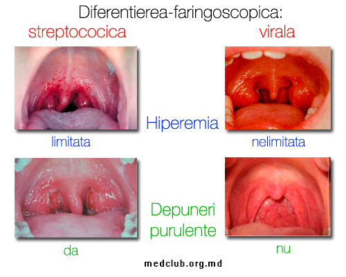 faringita